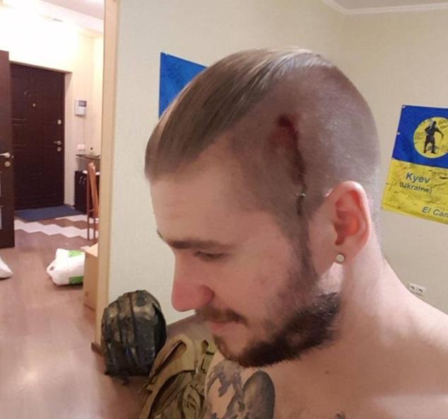 За словами АТОшніка Ананьєва, у нього на голові тепер є шрам після нападу невідомих